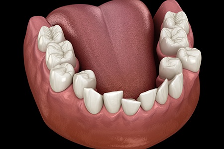 Illustration of crooked bottom teeth