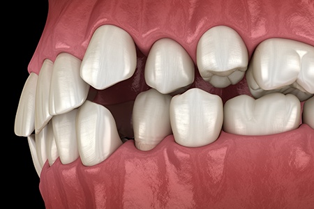 Illustration of spaced out teeth