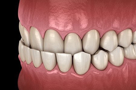 a 3D illustration of misaligned teeth