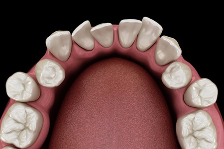 a 3D depiction of crooked teeth