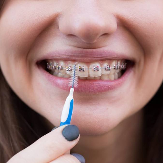 a person brushing between their braces
